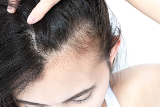 hair loss